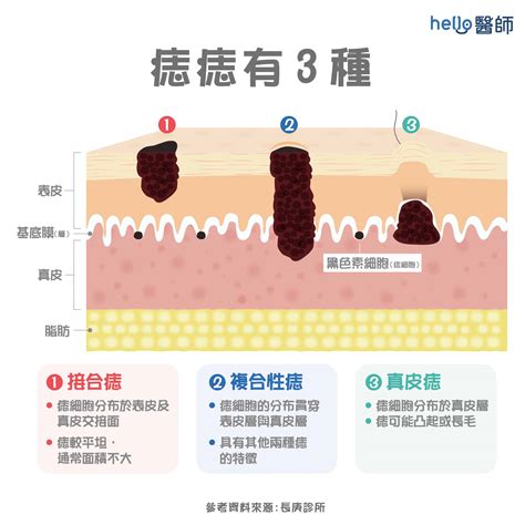 身上有很多痣|為什麼臉上的痣越來越多？皮膚科醫師解析長痣原因、。